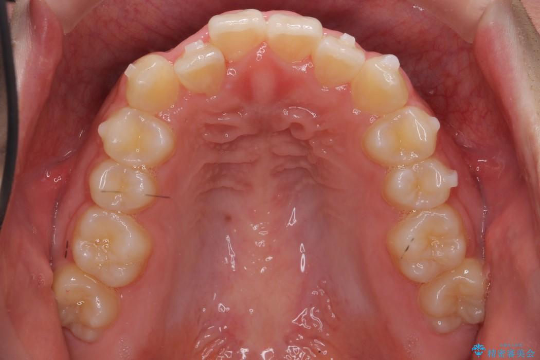 後ろに引っ込んだ前歯(2番の歯)をアライナーで治療 治療中画像