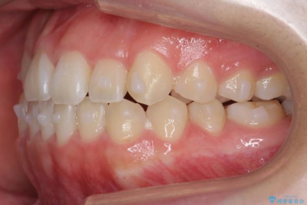 後ろに引っ込んだ前歯(2番の歯)をアライナーで治療 治療中画像