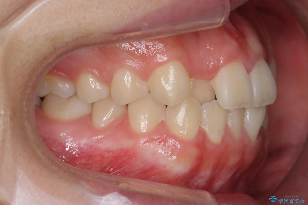 後ろに引っ込んだ前歯(2番の歯)をアライナーで治療 治療前画像