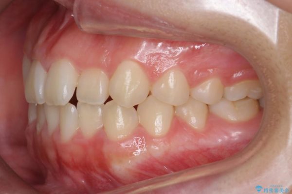 後ろに引っ込んだ前歯(2番の歯)をアライナーで治療 治療前画像