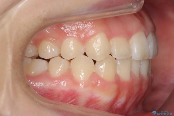 後ろに引っ込んだ前歯(2番の歯)をアライナーで治療 治療後画像