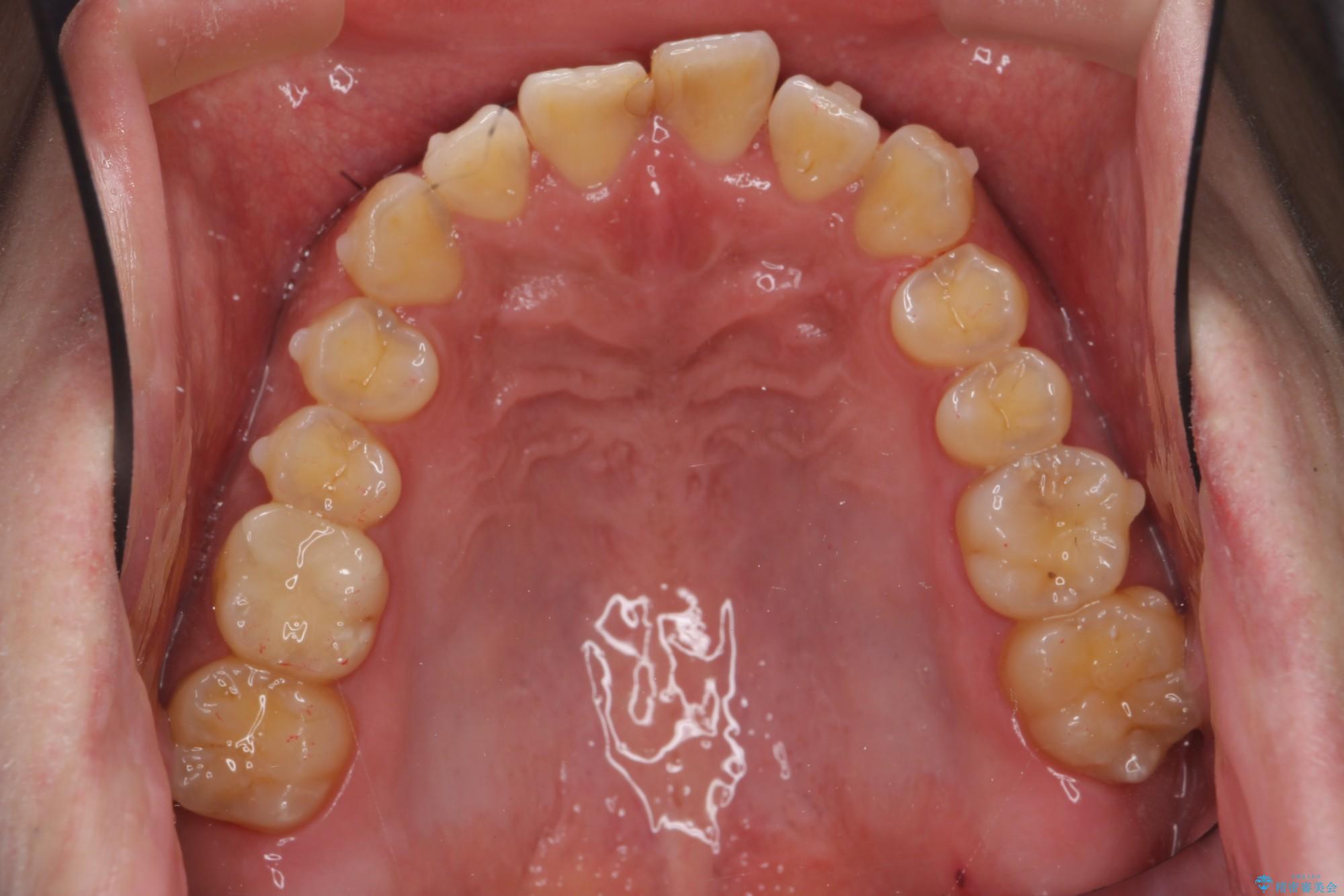 ねじれた前歯のマウスピースによる矯正 治療中画像