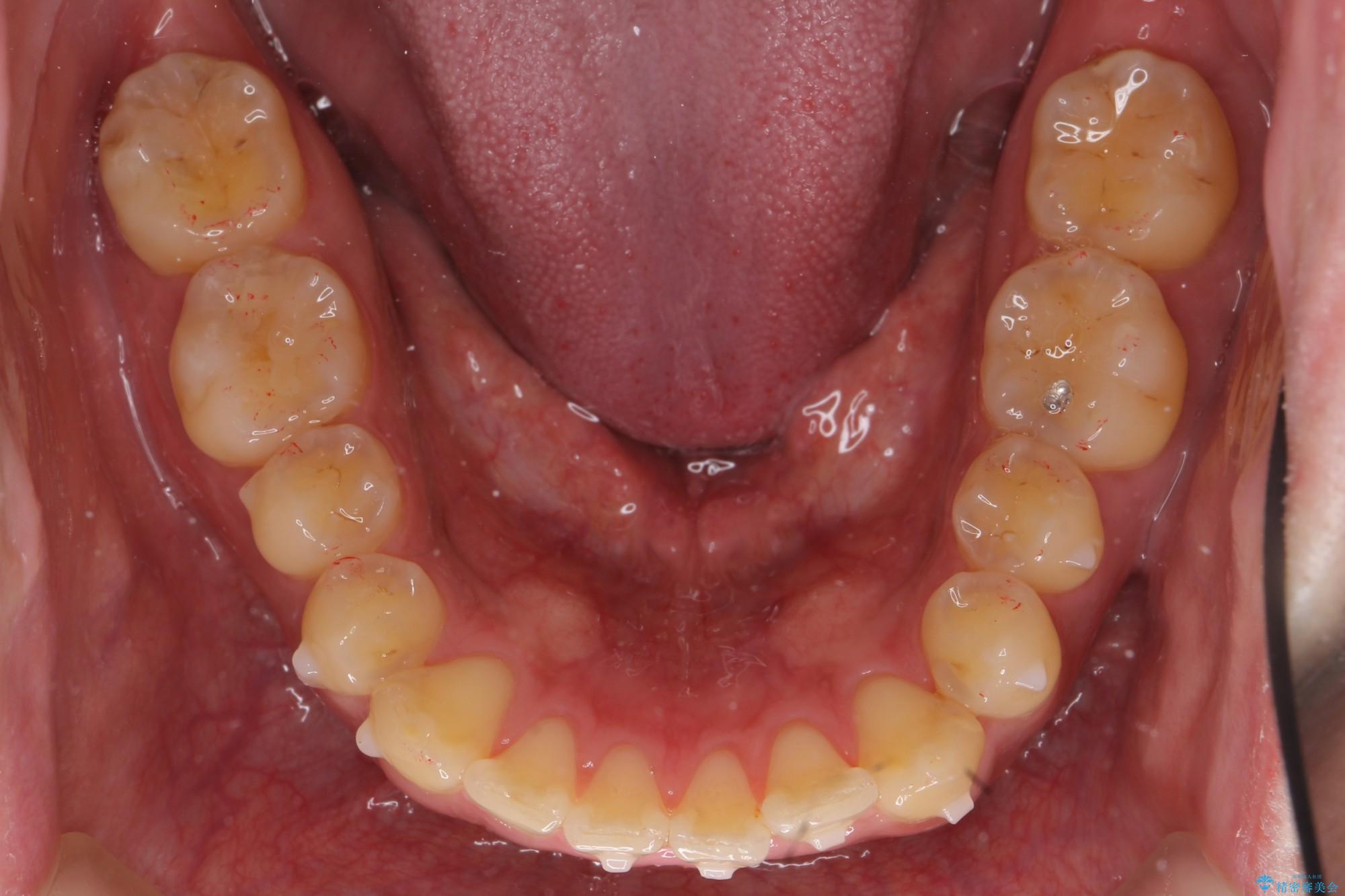 ねじれた前歯のマウスピースによる矯正 治療中画像