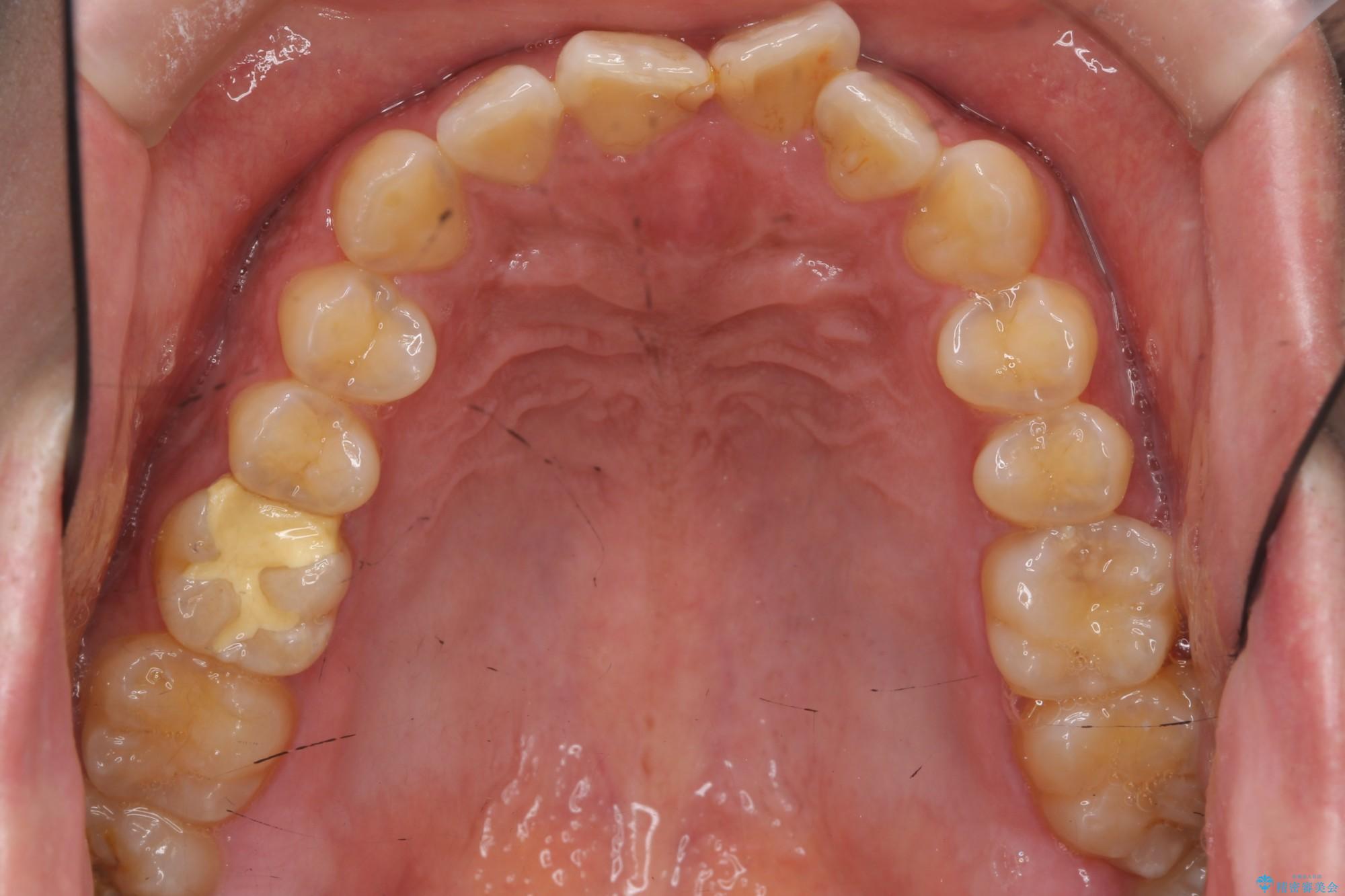 ねじれた前歯のマウスピースによる矯正 治療前画像
