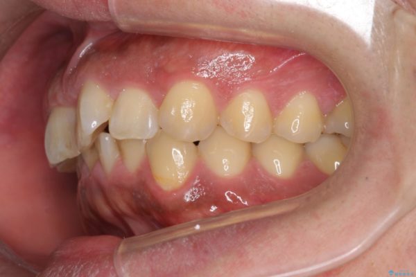 ねじれた前歯のマウスピースによる矯正 治療前画像