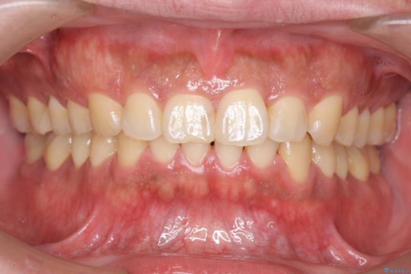 ねじれた前歯のマウスピースによる矯正 治療後画像