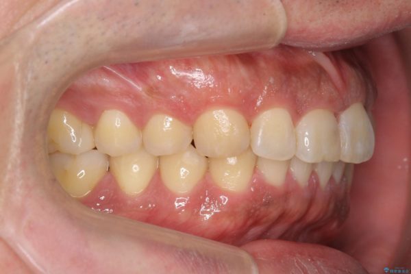 ねじれた前歯のマウスピースによる矯正 治療後画像