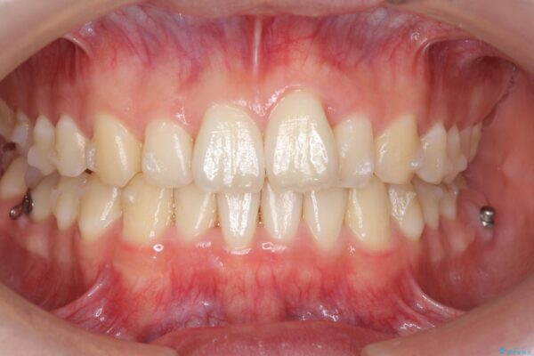 格安マウスピースでは不可能な前歯のがたつき・すれちがい咬合を矯正 治療中画像