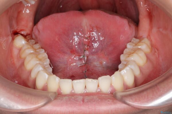 舌小帯形成術で気になる滑舌を改善 治療中画像