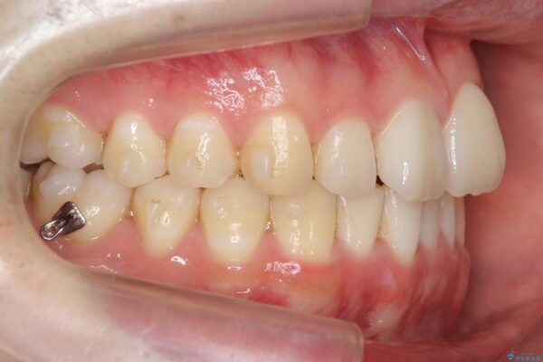 格安マウスピースでは不可能な前歯のがたつき・すれちがい咬合を矯正 治療中画像