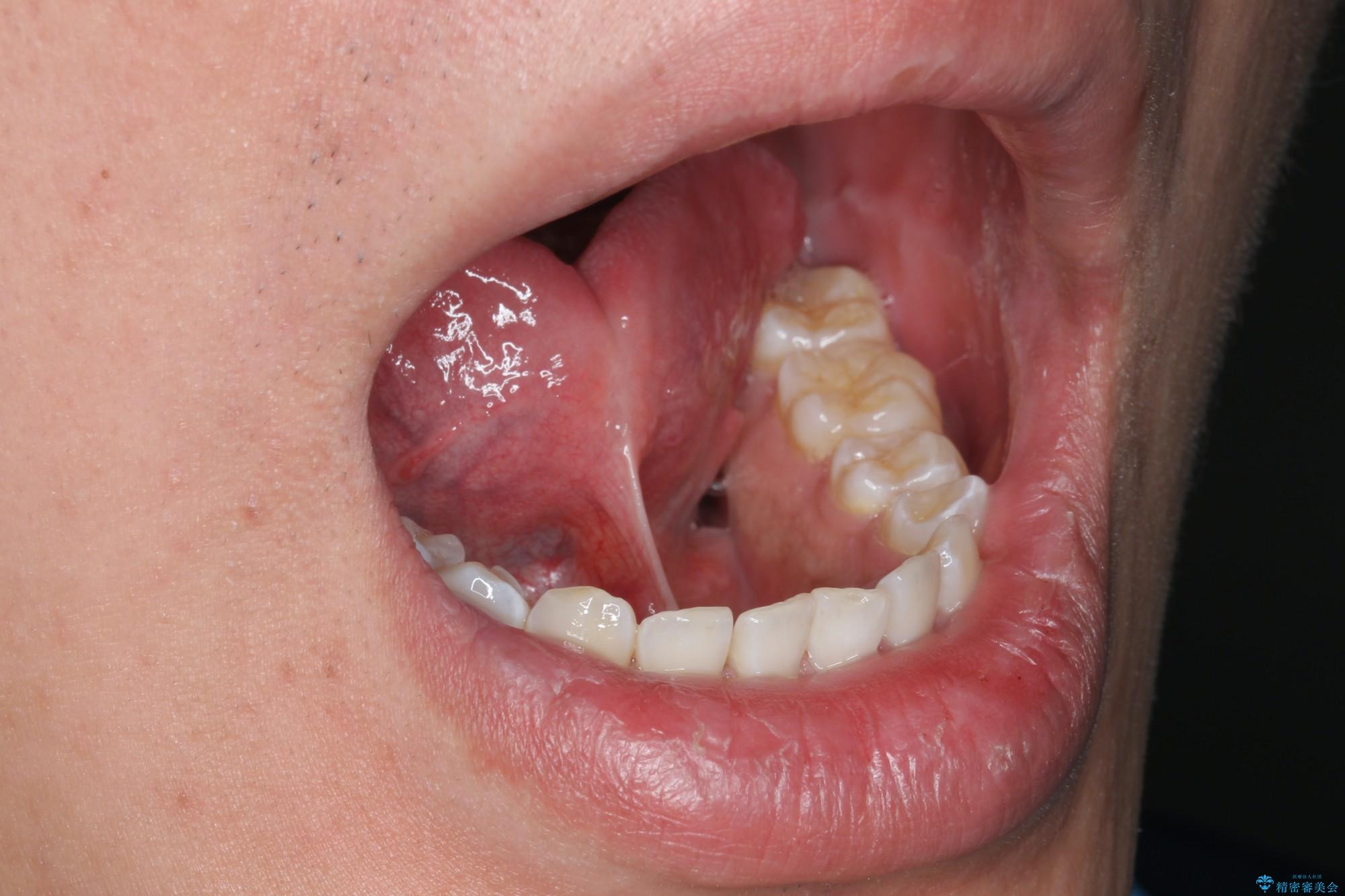 嘴里的两条“带” 之 舌系带/上唇系带过短 - 知乎