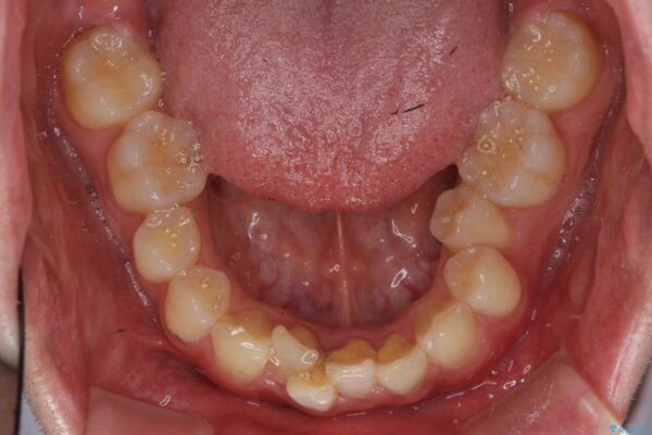 格安マウスピースでは不可能な前歯のがたつき・すれちがい咬合を矯正 治療前画像
