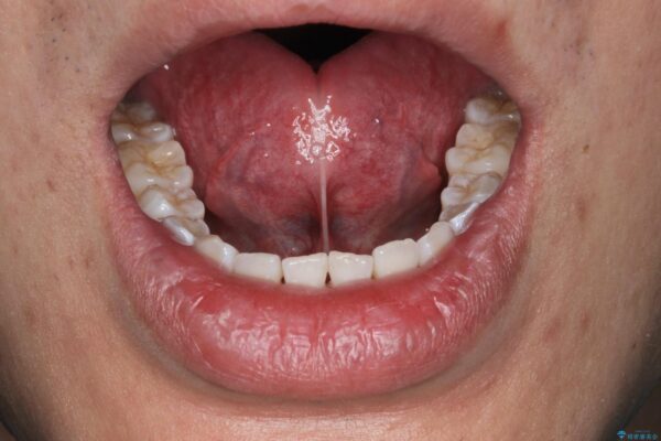 舌小帯形成術で気になる滑舌を改善 治療前画像
