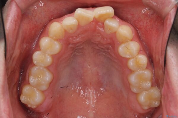 格安マウスピースでは不可能な前歯のがたつき・すれちがい咬合を矯正 治療前画像
