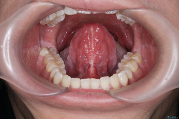 舌小帯形成術で気になる滑舌を改善 治療後画像