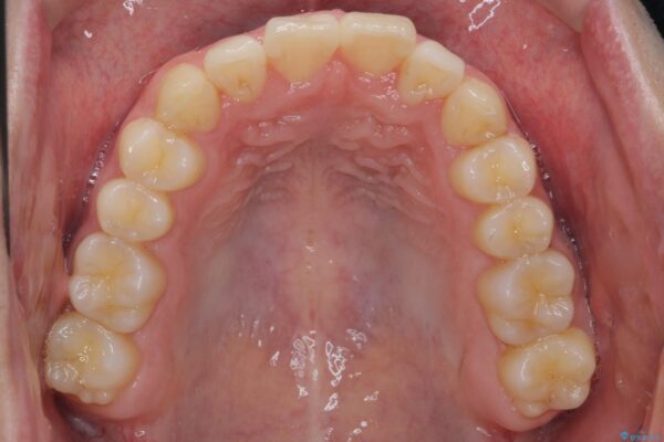 格安マウスピースでは不可能な前歯のがたつき・すれちがい咬合を矯正 治療後画像