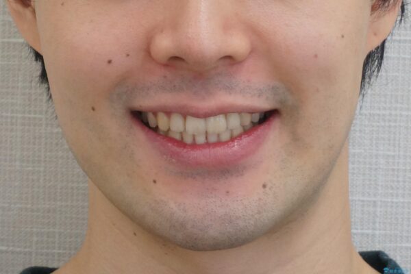 格安マウスピースでは不可能な前歯のがたつき・すれちがい咬合を矯正 治療後画像