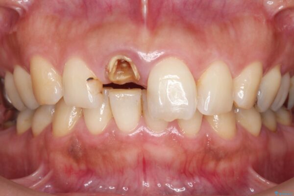 オールセラミックによる折れてしまった前歯の審美治療 治療前画像