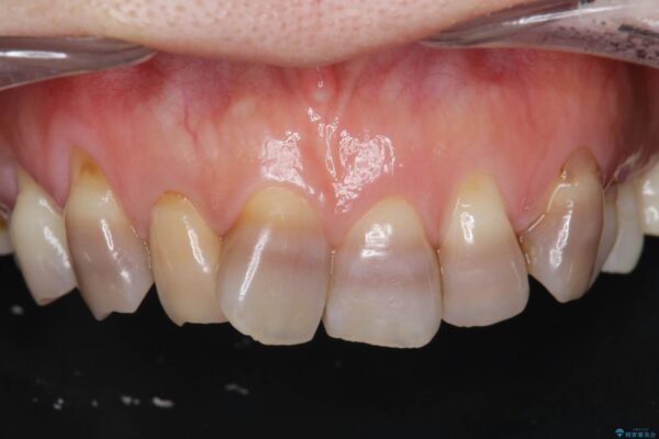 変色歯の審美治療　[ テトラサイクリン歯 ] 治療前画像