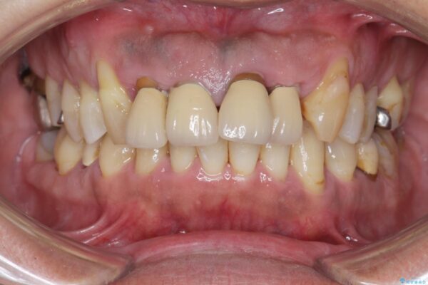 インプラント・ブリッジ補綴を含めた、歯周病の全顎治療 ビフォー