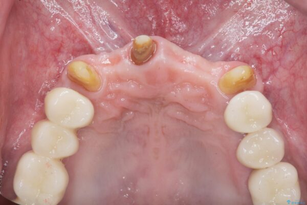 インプラント・ブリッジ補綴を含めた、歯周病の全顎治療 治療中画像
