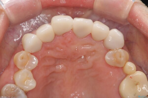 変色歯の審美治療　[ テトラサイクリン歯 ] 治療後画像