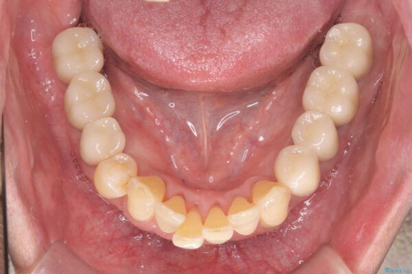 インプラント・ブリッジ補綴を含めた、歯周病の全顎治療 治療後画像