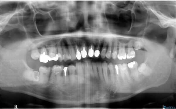 インプラント・ブリッジ補綴を含めた、歯周病の全顎治療 治療前画像
