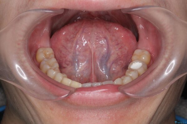 短い舌を改善したい[ 舌小帯形成術 ] 治療前画像