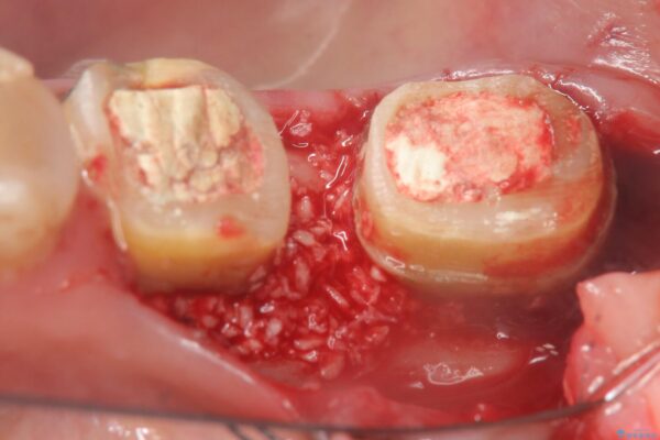 再生治療で歯周病の歯を残す 治療前画像