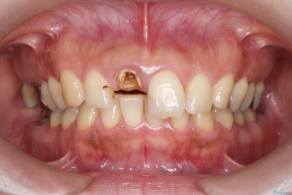 オールセラミックによる折れてしまった前歯の審美治療 治療前画像