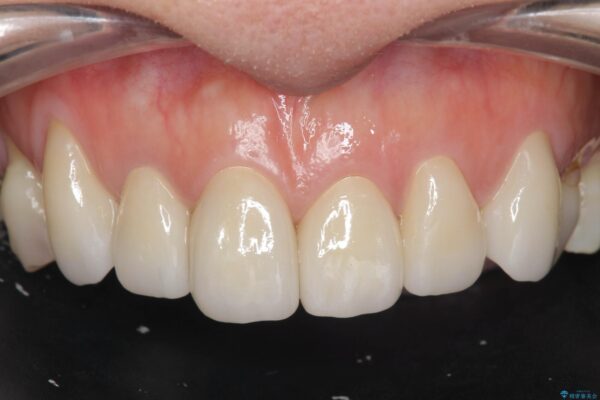 変色歯の審美治療　[ テトラサイクリン歯 ] 治療後画像