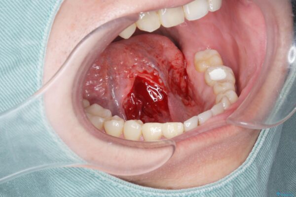 短い舌を改善したい[ 舌小帯形成術 ] 治療中画像