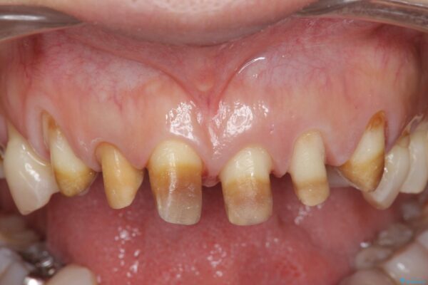 変色歯の審美治療　[ テトラサイクリン歯 ] 治療中画像