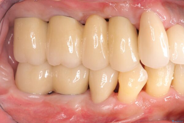 インプラント・ブリッジ補綴を含めた、歯周病の全顎治療 治療後画像