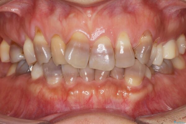 変色歯の審美治療　[ テトラサイクリン歯 ] 治療前画像