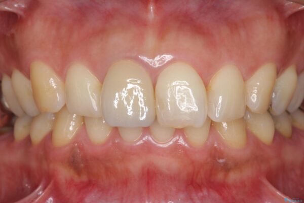 オールセラミックによる折れてしまった前歯の審美治療 治療後画像