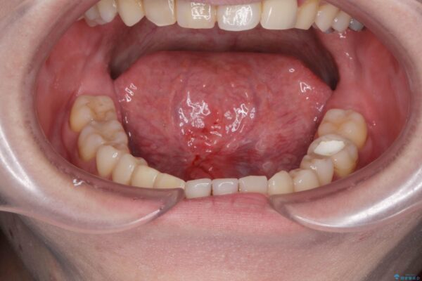 短い舌を改善したい[ 舌小帯形成術 ] 治療後画像