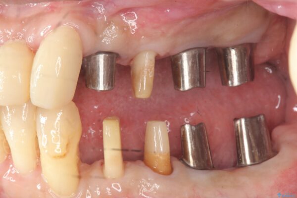 インプラント・ブリッジ補綴を含めた、歯周病の全顎治療 治療中画像