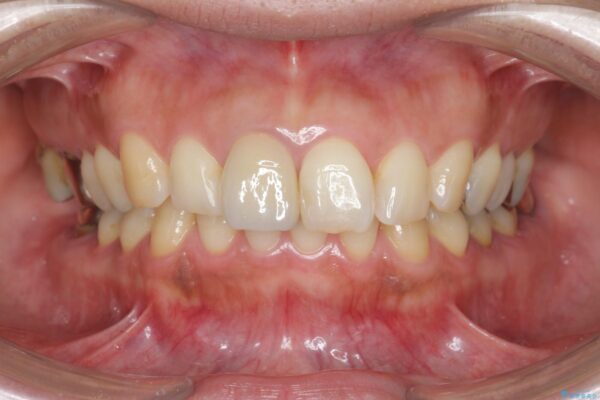 オールセラミックによる折れてしまった前歯の審美治療 治療後画像