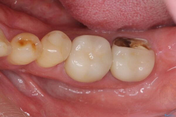 被せ物が割れた、虫歯の再発の治療 ビフォー