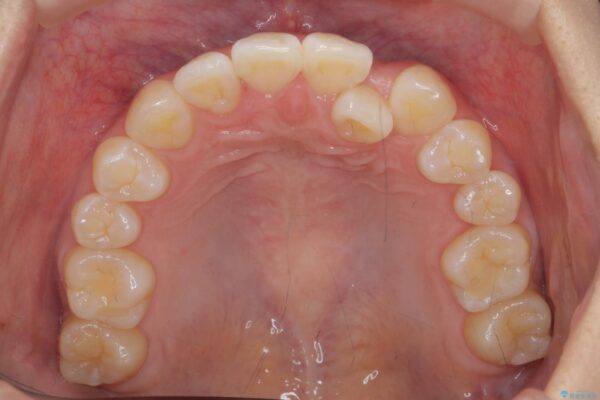 引っ込んだ前歯、正中のズレの矯正 治療前画像