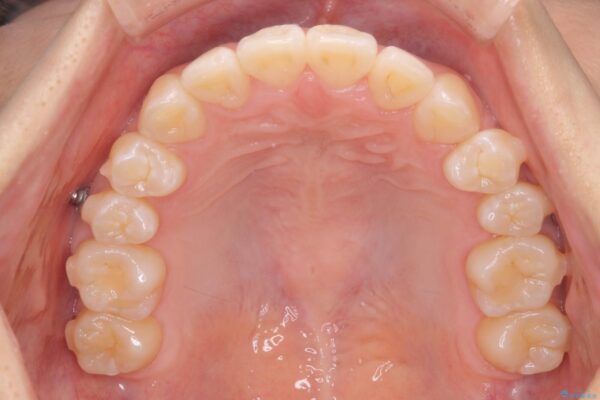 引っ込んだ前歯、正中のズレの矯正 治療中画像