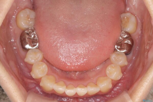 引っ込んだ前歯、正中のズレの矯正 治療中画像