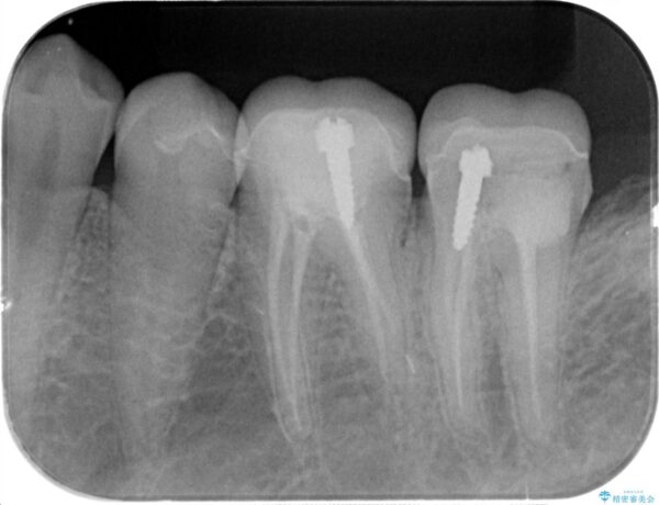 被せ物が割れた、虫歯の再発の治療 治療前画像