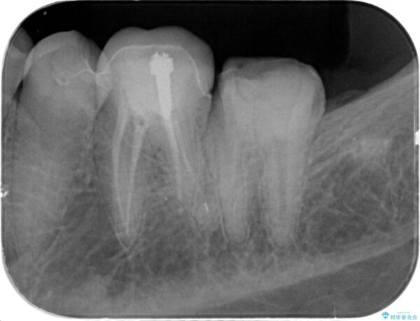 被せ物が割れた、虫歯の再発の治療 治療中画像