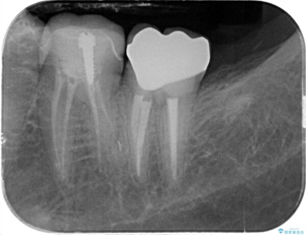 被せ物が割れた、虫歯の再発の治療 治療後画像