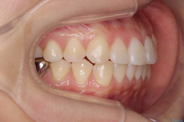 引っ込んだ前歯、正中のズレの矯正 治療後画像