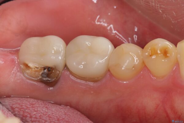 被せ物が割れた、虫歯の再発の治療 治療前画像