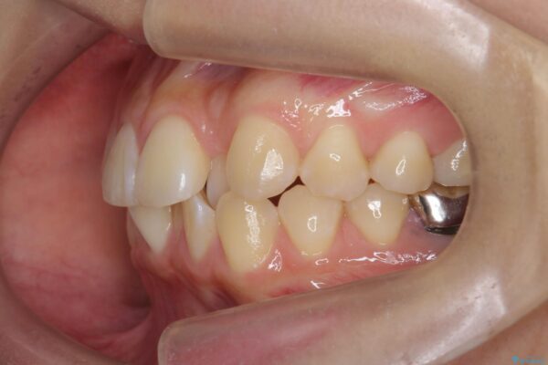 引っ込んだ前歯、正中のズレの矯正 治療前画像